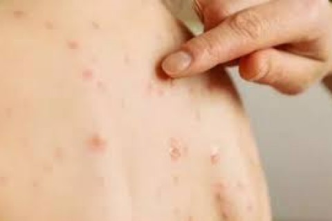 Brasil registra 34 casos de sarampo; Ministério da Saúde emite alerta