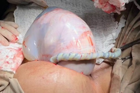 Parto raríssimo na Bahia: gêmeas nascem e uma chega ao mundo empelicada